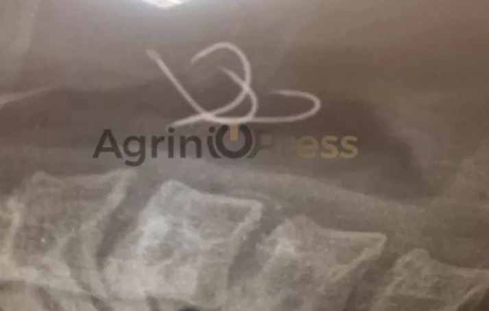 Shock in Agrinio: Hooks "sat down" on the 38 -year -old's esophagus who ate octopus